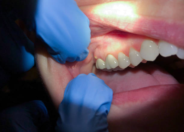 Best Emergency Dentist for Lost Fillings or Crowns in Gresham, OR